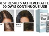 Follinique Hair Regrowth Treatment Follinique Uses Side Effects Price Interactions and